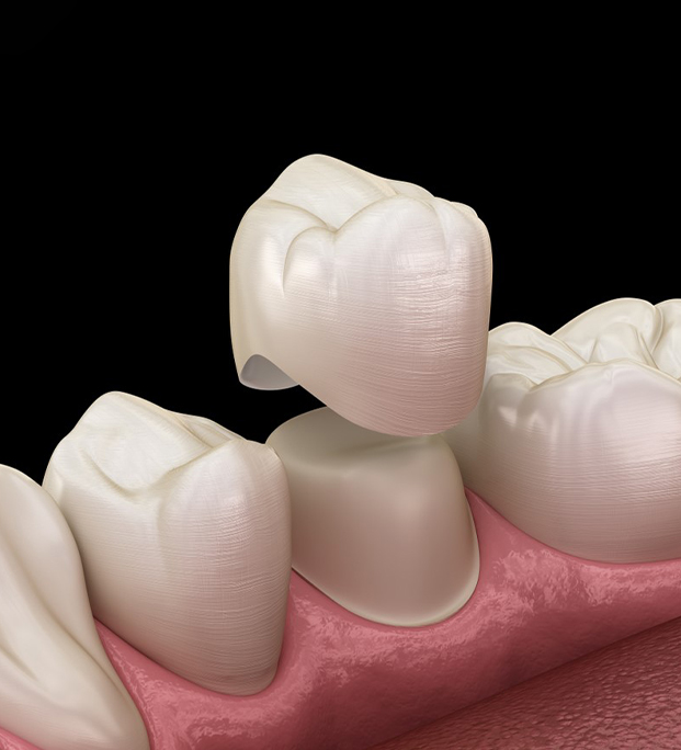 Dental crown restoration showing tooth-colored ceramic crown placement on implant with pink gum tissue model.