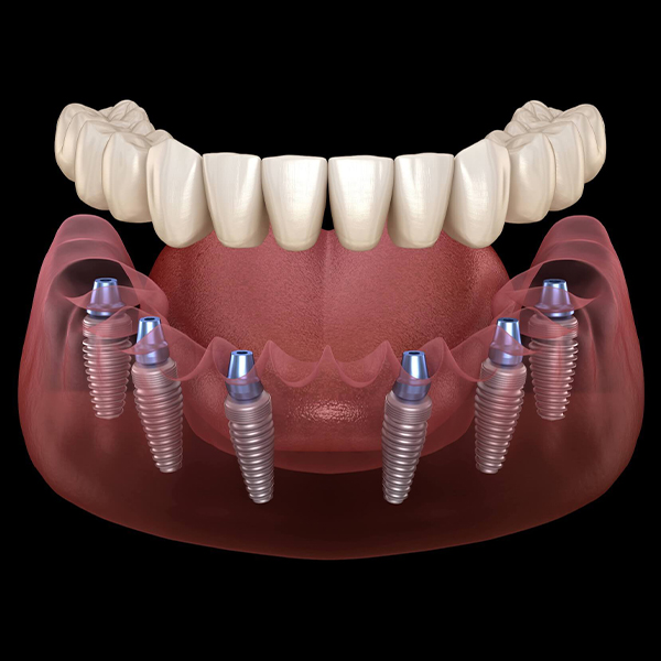 Dental implant prosthesis model showing eight implants with tooth-colored crown restoration on dark red base.