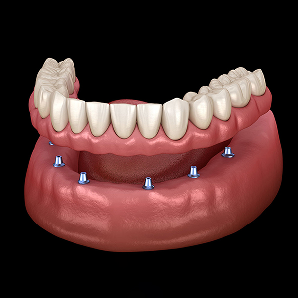 All-on-4 dental implant prosthesis showing implant placement and tooth restoration on jawbone model.