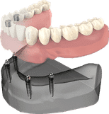Dental implant model showing prosthetic teeth attachment on jawbone structure for patient education.