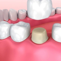 Dental crown restoration visualization showing tooth replacement procedure on gum model.