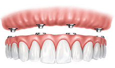 Dental implant crown bridge illustration showing prosthetic teeth restoration on gum model.