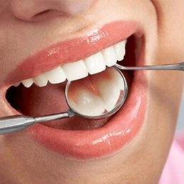 Close-up of patient's mouth during dental examination with mirror and tools in clinical setting.