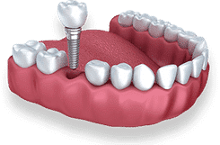 Dental implant model showing tooth replacement procedure with artificial tooth and screw fixture in gum.